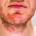 I prodotti per il viso da uomo possono essere usati per le malattie della pelle?