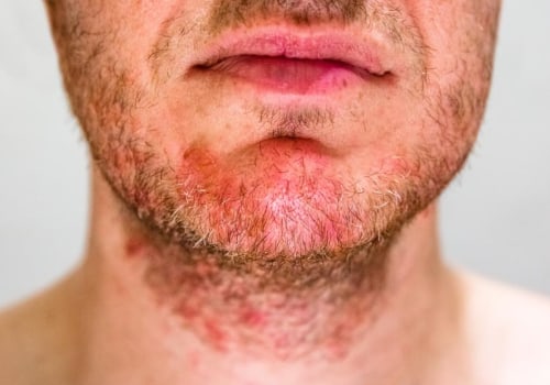 I prodotti per il viso da uomo possono essere usati per le malattie della pelle?